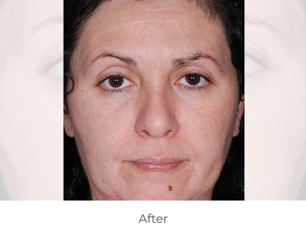 mdceuticals_before-after_1A