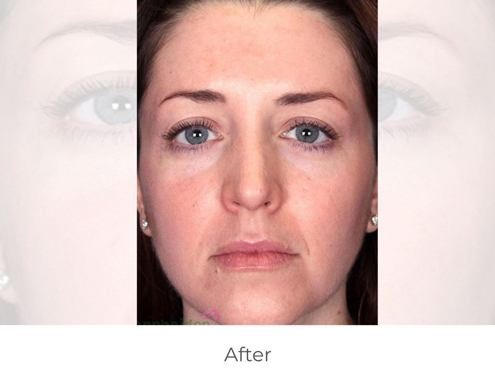 mdceuticals_before-after_2A