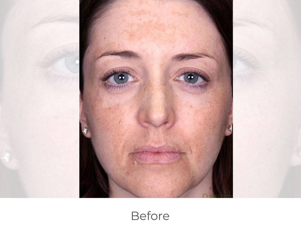 mdceuticals_before-after_2B